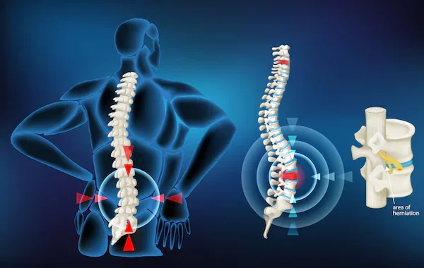 Slipped Disc Treatment